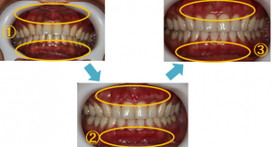 歯茎4
